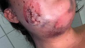 'Blood bubbling out the side of my face when I was breathing'  - Teen injured  in Galliagh car burning
