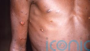27 cases of monkeypox detected in Northern Ireland