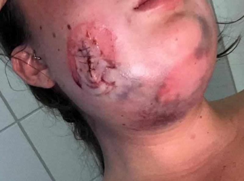 'Blood bubbling out the side of my face when I was breathing'  - Teen injured  in Galliagh car burning