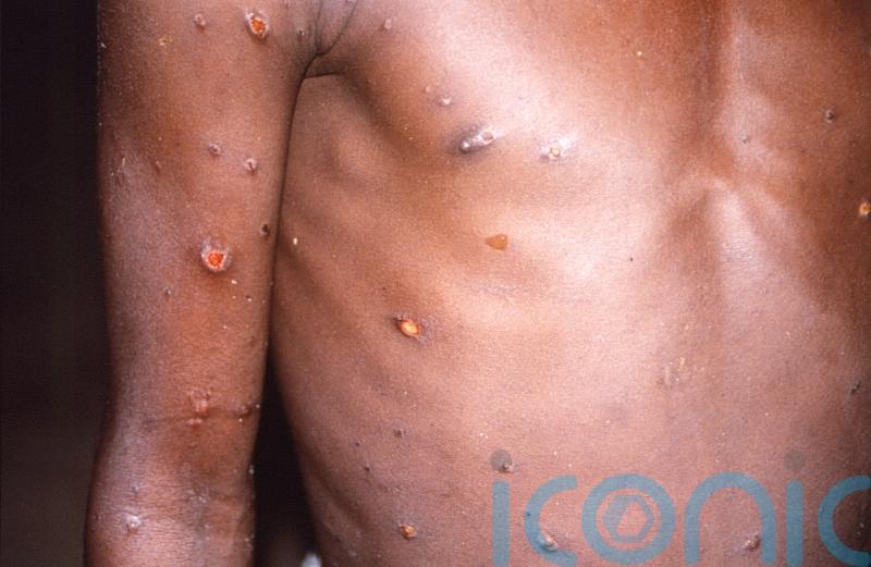 27 cases of monkeypox detected in Northern Ireland